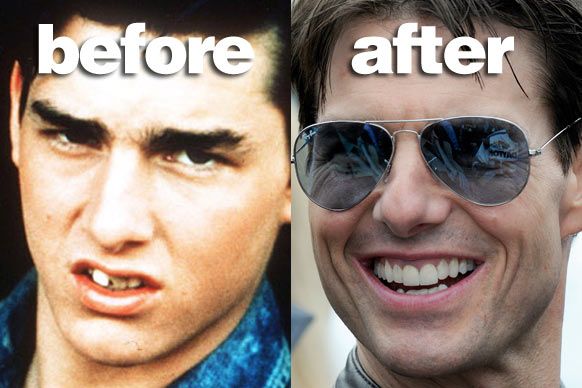 23 звезди преди и след новите зъби 
