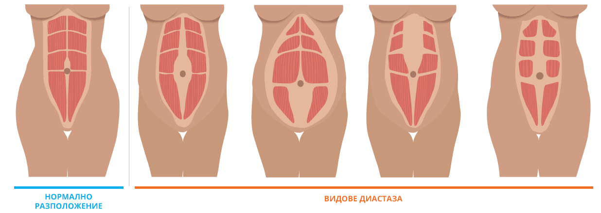 Диастазата - важна тема за женското здраве